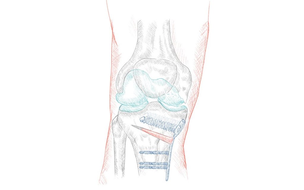 Osteotomia Do Joelho Ortopedistas