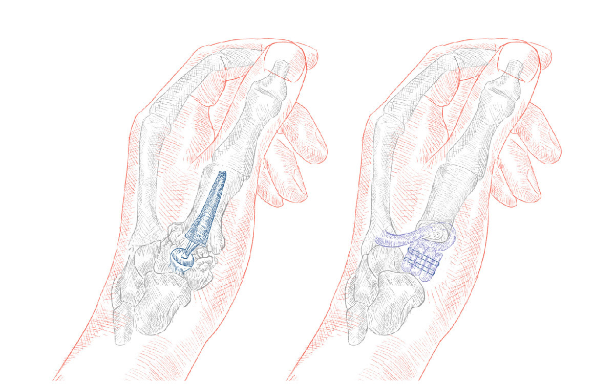 Artroplastia Da Base Do Polegar Ortopedistas